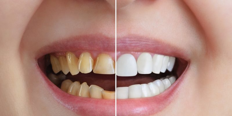 BEFORE AND AFTER