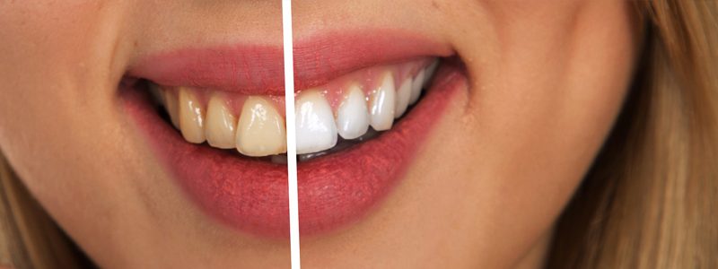 Teeth Whitening