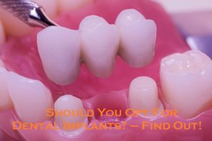 Should You Opt For Dental Implants? – Find Out!